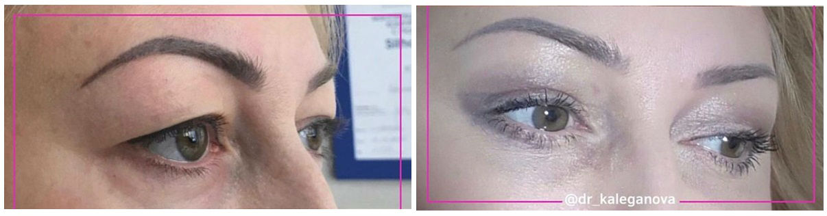 Фото до и после операции у пластического хирурга Калегановой Анны Юрьевны