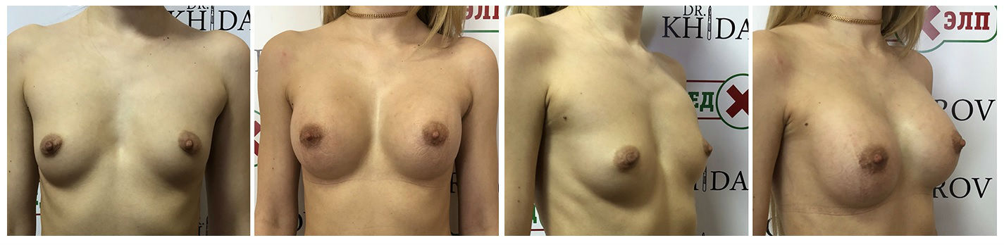 Фото до и после операции увеличения груди у пластического хирурга Хайдарова Тимура Тошниёзовича