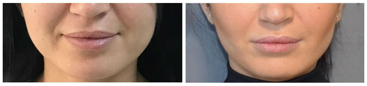Фото до и после операции коррекции щек у пластического хирурга Кирилловой Киры Анатольевны
