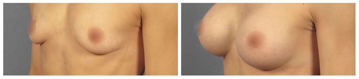 Фото до и после операции коррекции груди у пластического хирурга Кирилловой Киры Анатольевны