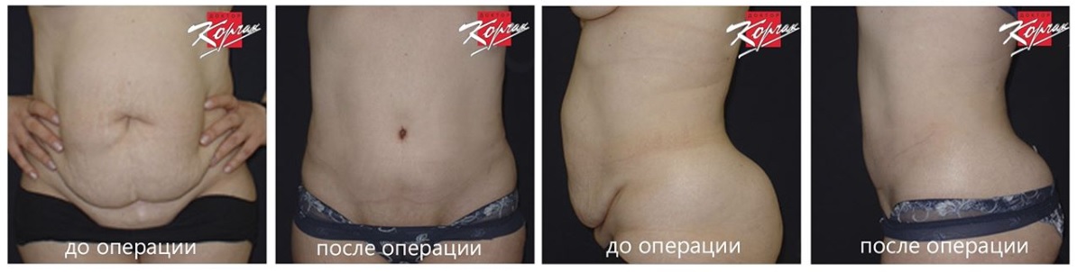 Фото до и после операции у пластического хирурга Корчака Владимира Васильевича
