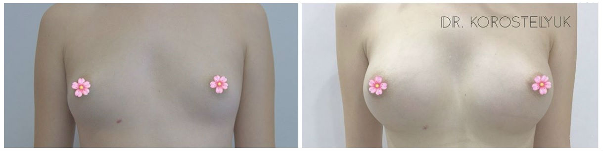 Фото до и после операции увеличения груди у пластического хирурга Коростелюка Юрия Витальевича