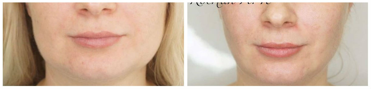 Фото до и после операции коррекции овала лица у пластического хирурга Костина Александра Павловича