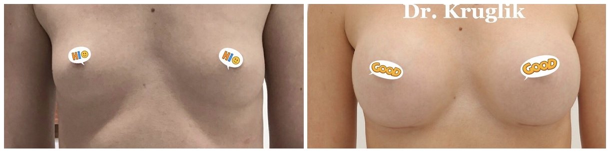 Фото до и после операции маммопластики у пластического хирурга Круглика Сергея Викторовича