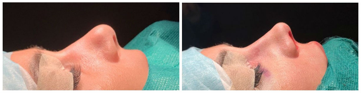 Фото до и после операции пластики носа у пластического хирурга Кузина Данилы Александровича