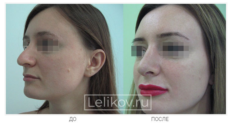 Фото до и после операции ринопластики у пластического хирурга Леликова Кирилла Славовича