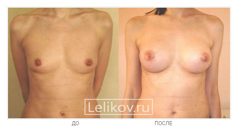 Фото до и после операции маммопластики у пластического хирурга Леликова Кирилла Славовича