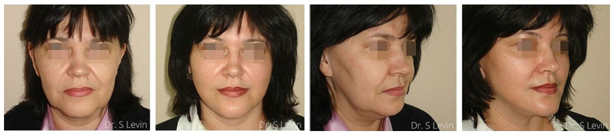 Фото до и после подтяжки лица у пластического хирурга Левина Сергея Львовича