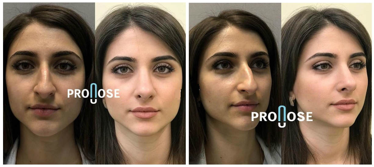 Фото до и после пластики носа у пластического хирурга Липского Константина Борисовича