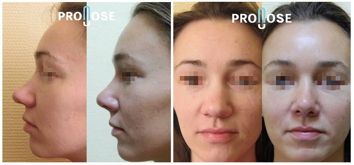 Фото до и после пластики носа у пластического хирурга Липского Константина Борисовича