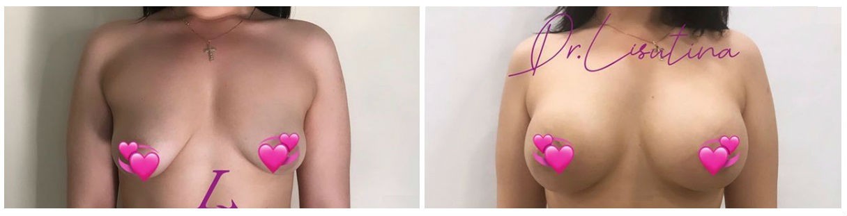 Фото до и после операции увеличения груди у пластического хирурга Лисутиной Марии Николаевны