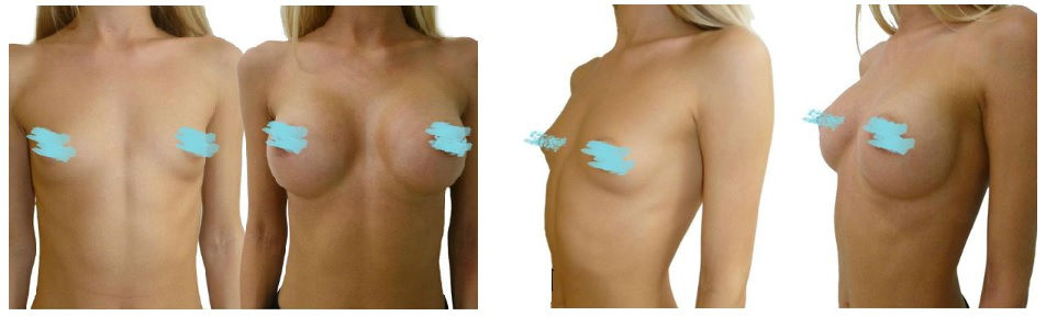 Фото до и после операции коррекции груди у пластического хирурга Лобачёва Кирилла Сергеевича