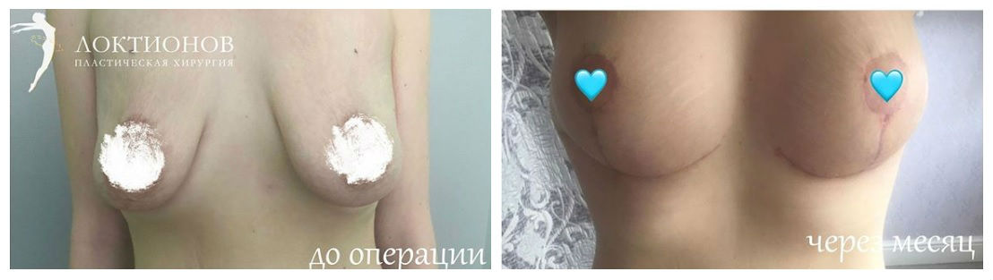 Фото до и после операции маммопластики у пластического хирурга Локтионова Андрея Геннадьевича