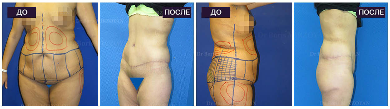Фото до и после бодилифтинга у пластического хирурга Азизяна Ваагна Самвеловича