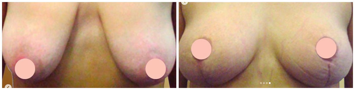 Фото до и после подтяжки груди у пластического хирурга Никитина Олега Леонидовича