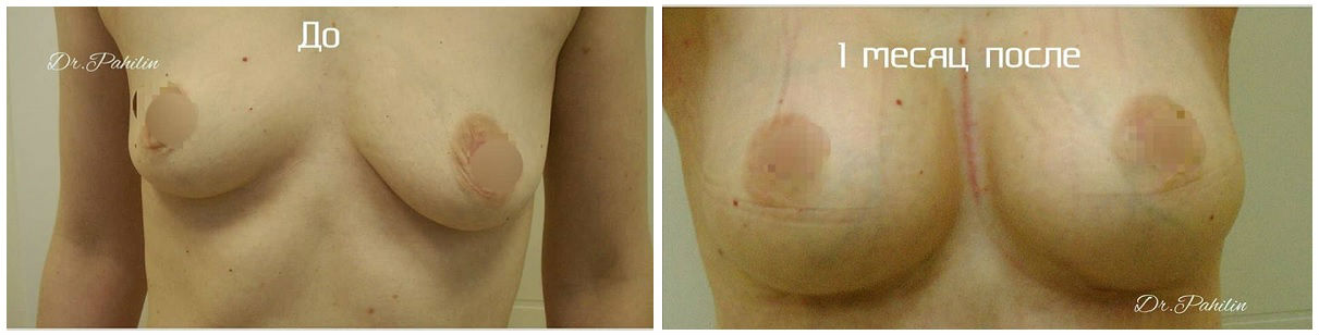 Фото до и после операции пластики груди у пластического хирурга Пахилина Дмитрия Викторовича