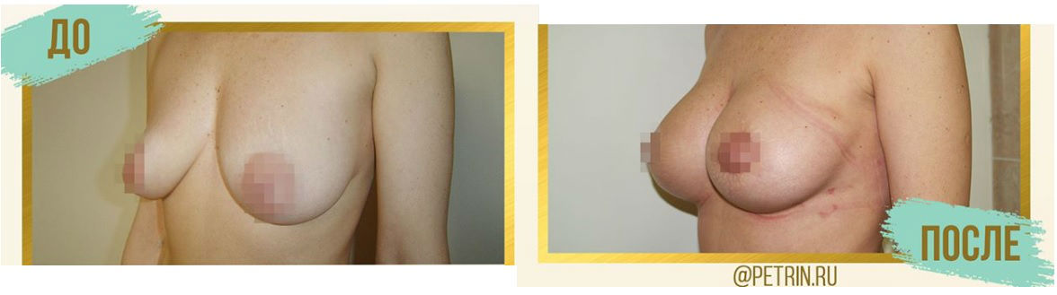Фото до и после операции увеличения груди у пластического хирурга Петрина Сергея Александровича