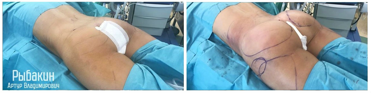 Фото до и после липопластики у пластического хирурга Рыбакина Артура Владимировича