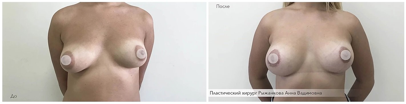 Фото до и после операции у пластического хирурга Рыжанковой Анны Вадимовны
