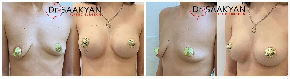 Фото до и после операции увеличения груди у пластического хирурга Саакян Сюзанны Вачагановны