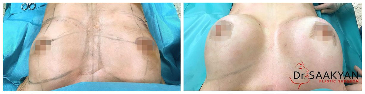 Фото до и после операции у пластического хирурга Саакян Сюзанны Вачагановны