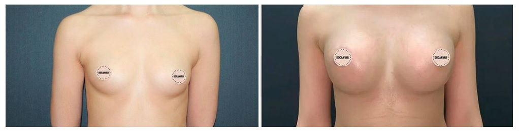 Фото до и после операции увеличения груди у пластического хирурга Салиджанова Анвара Шухратовича