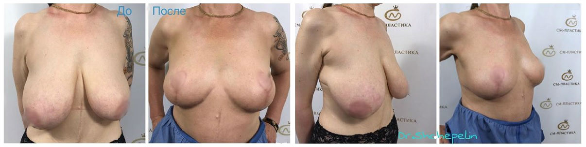 Фото до и после операции пластики груди у пластического хирурга Щепелина Михаила Андреевича