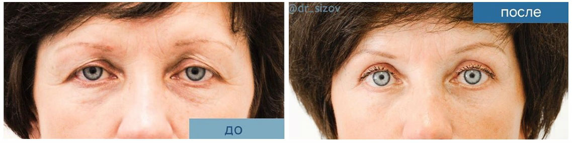Фото до и после блефаропластики у пластического хирурга Сизова Сергея Владимировича