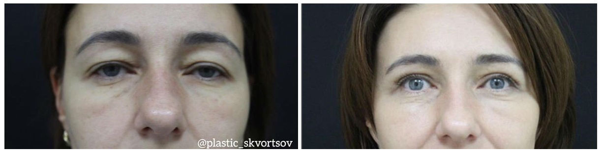 Фото до и после операции пластики век у пластического хирурга Скворцова Дмитрия Сергеевича