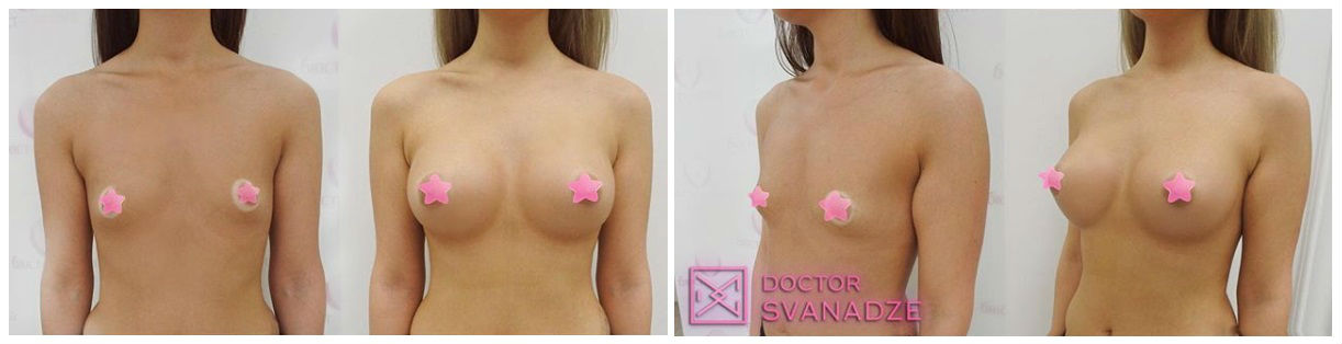 Фото до и после операции увеличения груди у пластического хирурга Сванадзе Саломеи Николаевны