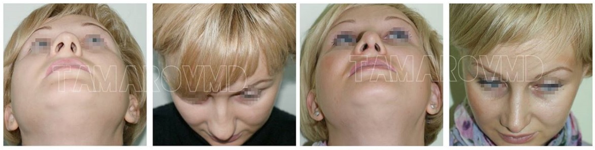 Фото до и после пластики носа у пластического хирурга Тамарова Алексея Николаевича