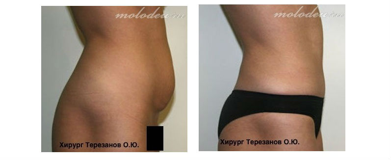 Фото до и после операции абдоминопластики у пластического хирурга Терезанова Олега Юрьевича