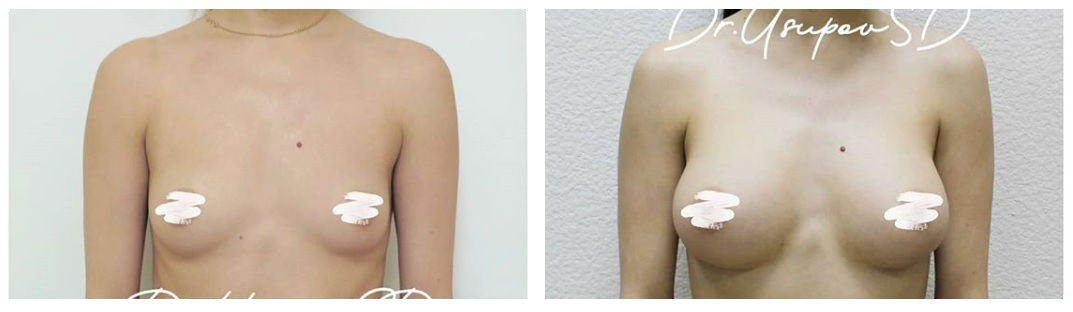 Фото до и после операции маммопластики у пластического хирурга Юсупова Саида Дошаловича