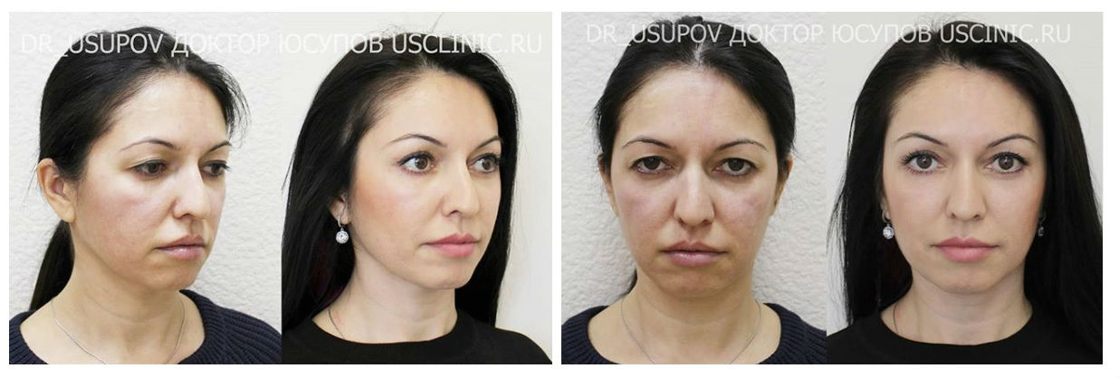 Фото до и после операции комплексной пластики у пластического хирурга Юсупова Саида Дошаловича
