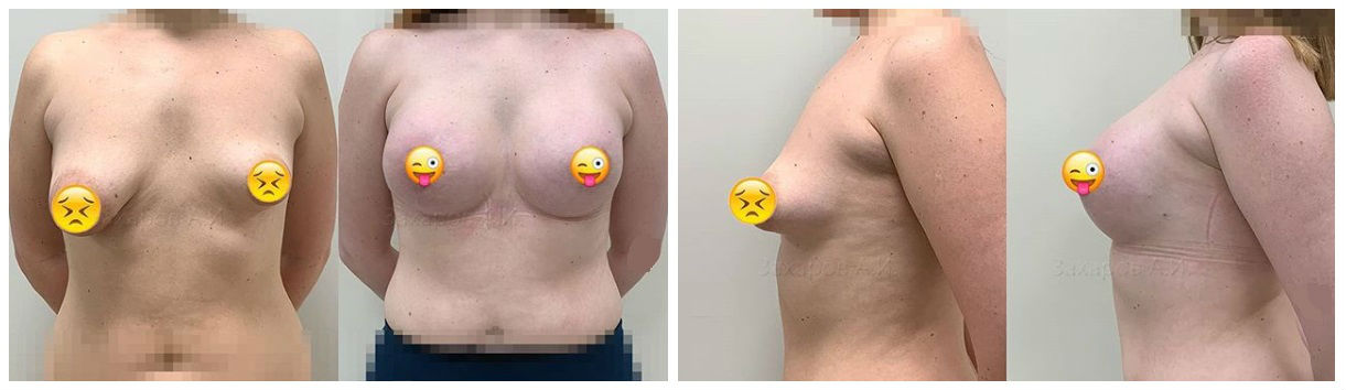 Фото до и после маммопластики у пластического хирурга Захарова Антона Игоревича
