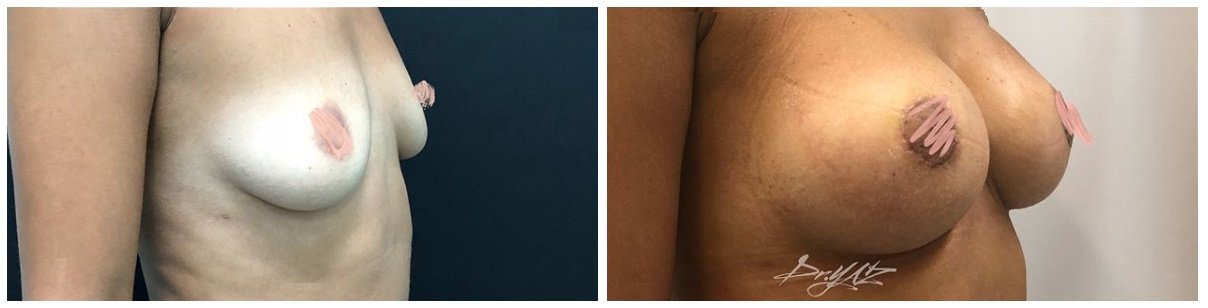 Фото до и после операции на груди у пластического хирурга Заякина Ярослава Алексеевича