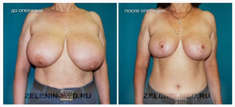 Фото до и после операции у пластического хирурга Зеленина Вадима Николаевича