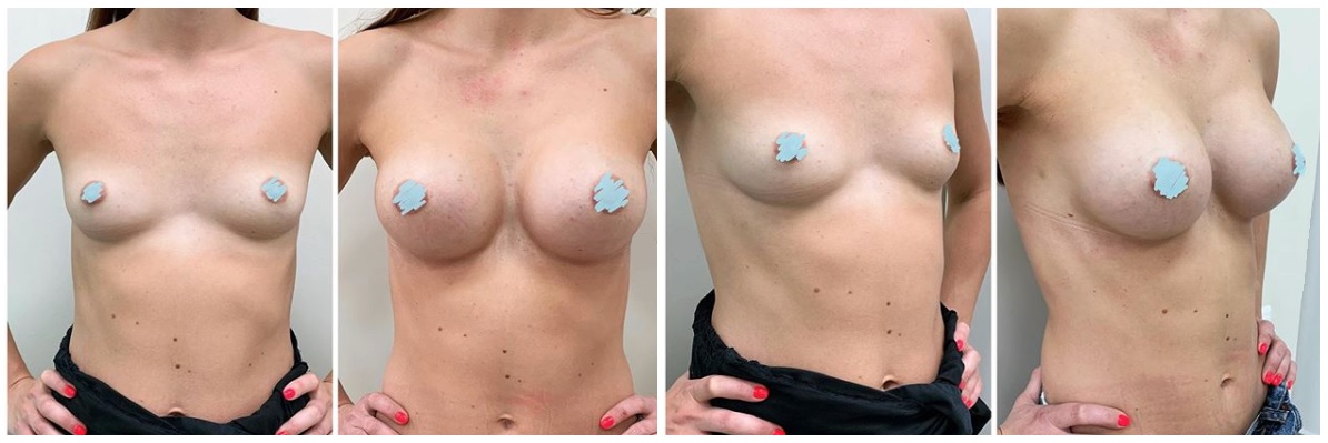 Фото до и после операции маммопластики у пластического хирурга Сакуты Александра Дмитриевича