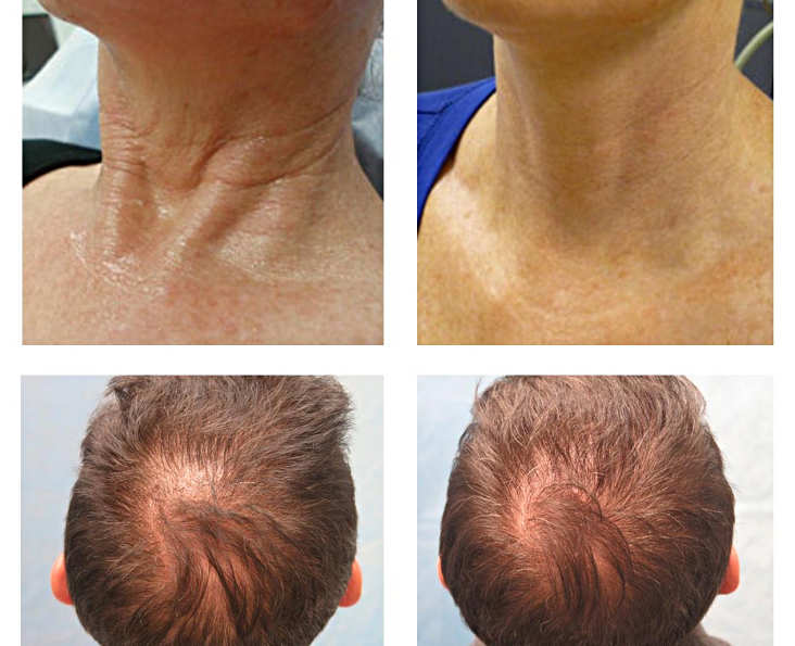 Фотографии до и после плазмолифтинга (PRP-терапии)