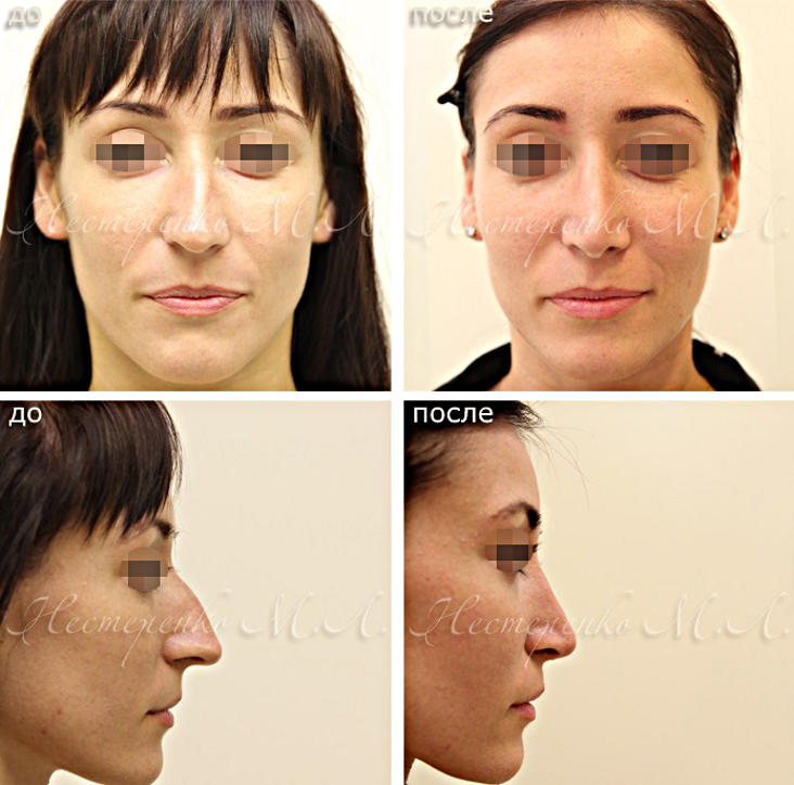Ринопластика носа в Москве - фото до и после операции