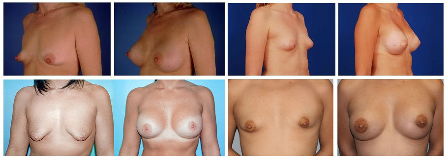 Фотографии до и после пластики тубулярной груди, цены в Москве