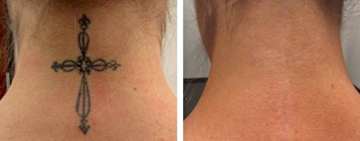 Лазерное удаление тату до и после процедуры
