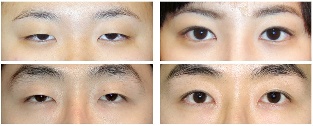 Фотографии до и после пластики азиатского разреза глаз, цены в Москве