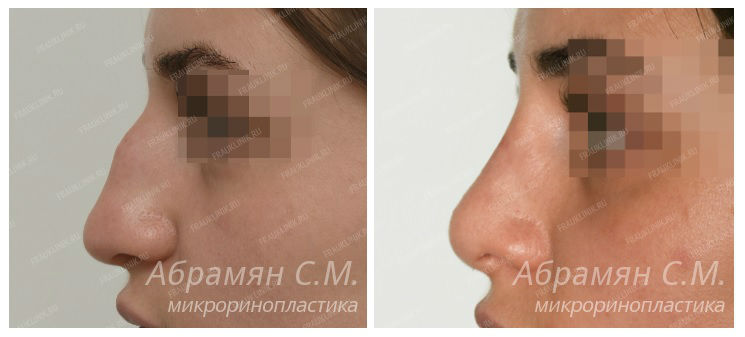 Фото до и после ринопластики у пластического хирурга Абрамяна Соломона Маисовича