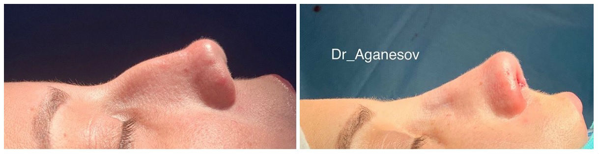 Фото до и после ринопластики у пластического хирурга Аганесова Георгия Александровича