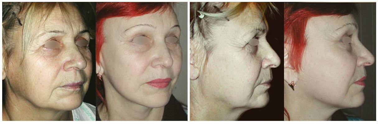 Фото до и после подтяжки лица у пластического хирурга Боровикова Алексея Михайловича