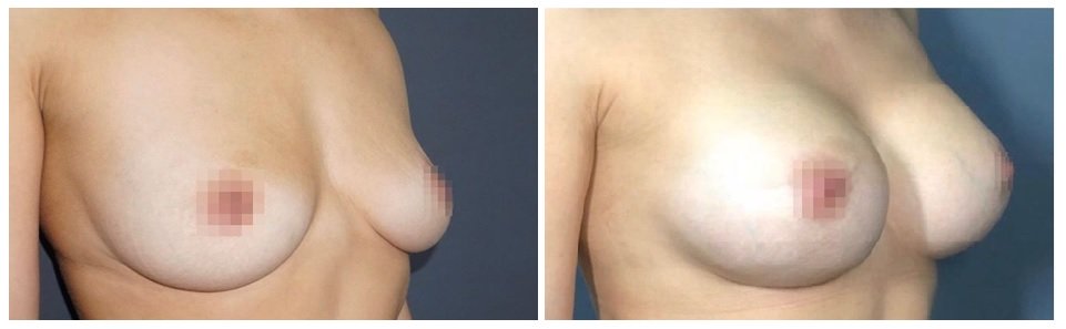 Фото до и после пластики груди у пластического хирурга Шемонаевой Ольги Михайловны