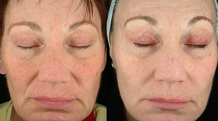 Фотодинамическая терапия в косметологии - фото до и после
