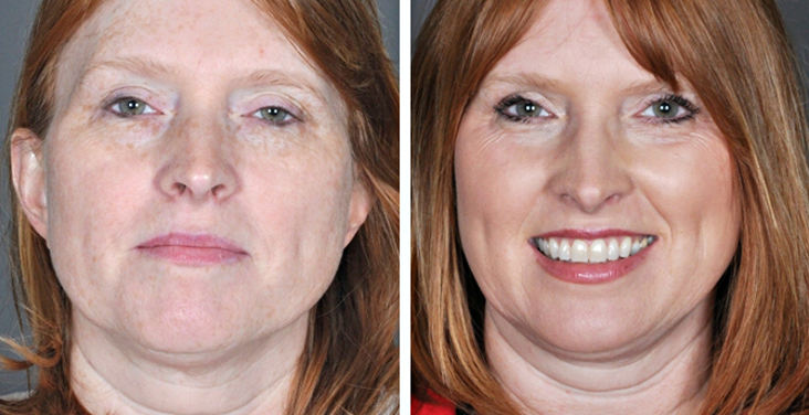 Фотографии до и после лазерной шлифовки лица