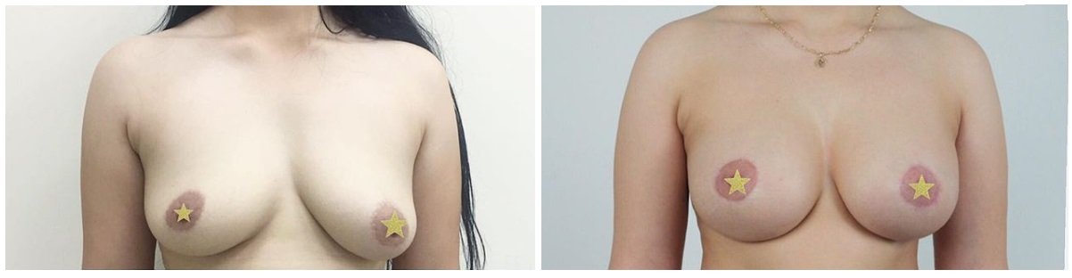Фото до и после маммопластики у пластического хирурга Асланяна Грача Микаеловича